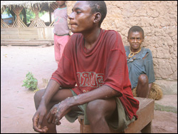 Yaws victim with multiple lesions on hands